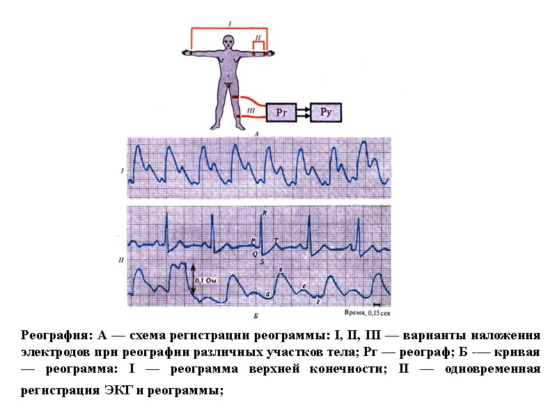 Реография: А — схема регистрации реограммы: I, II, III — варианты наложения электродов при